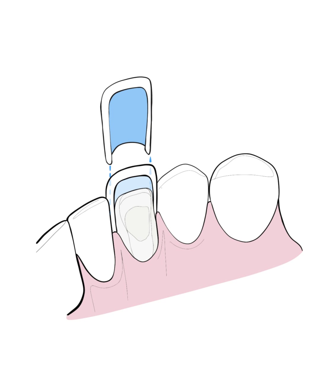 Veneer Lithium-Disilikat